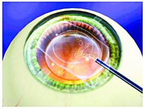 ICL人工晶體植入手術 ICL人工晶體植入手術