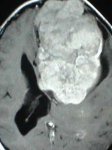 腦瘤後遺症 腦瘤後遺症