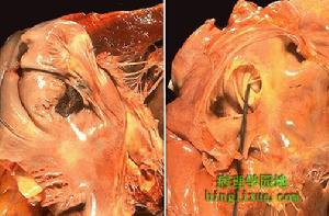 反常栓子 反常栓子