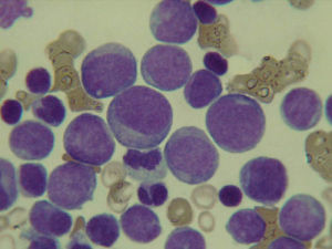 急性髓系白血病細胞