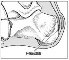 跟骨滑囊炎