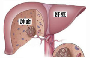 小肝癌