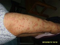 雷患者-紅皮型2-中國牛皮癬