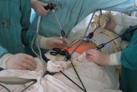 腹腔鏡手術 腹腔鏡手術