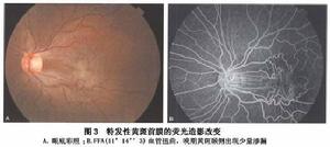 特發性黃斑部前膜