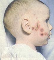 抗細菌免疫 抗細菌免疫