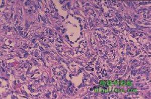 枸櫞酸桿菌肺炎