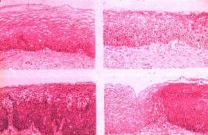 陰道上皮內瘤樣變 陰道上皮內瘤樣變