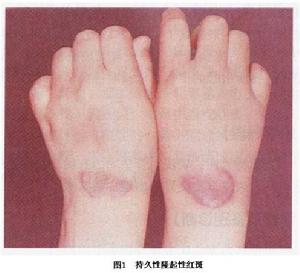 持久性隆起性紅斑