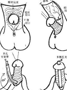 尿道下裂 尿道下裂