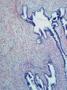 上皮內瘤變 上皮內瘤變