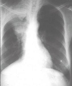 單純性肺嗜酸粒細胞浸潤症