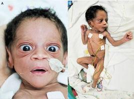 新生兒甲亢 新生兒甲亢