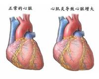 限制型心肌病 心臟擴大