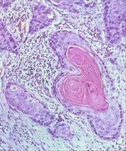 鱗狀細胞癌 鱗狀細胞癌