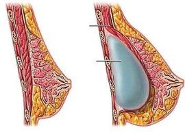 隆胸手術 隆胸手術