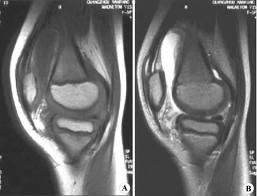 關節腫脹 關節腫脹