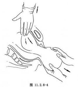 肩難產助產術 肩難產助產術