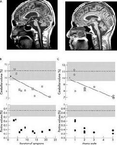 共濟失調症 共濟失調症