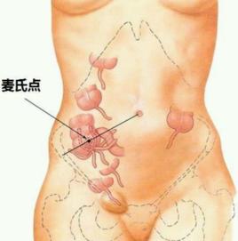 闌尾麥氏點 闌尾麥氏點