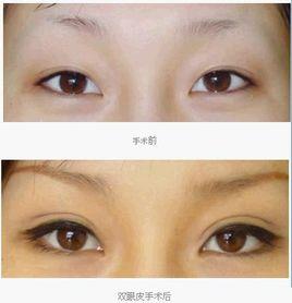 三點定位雙眼皮 三點定位雙眼皮