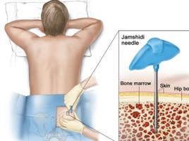 骨髓檢查 骨髓檢查