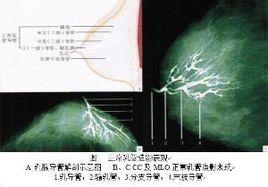 乳腺病變 乳腺病變