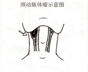 外科頸動脈體瘤 外科頸動脈體瘤