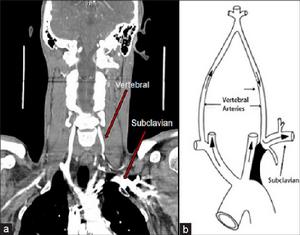 椎-基底動脈盜血綜合徵 椎-基底動脈盜血綜合徵