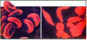 鐮刀型細胞貧血病