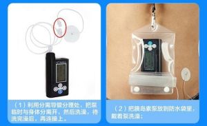 邁世通胰島素泵