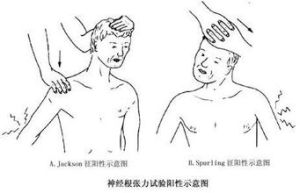 頸靜脈加壓試驗 頸靜脈加壓試驗