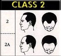 二級脫髮 二級脫髮