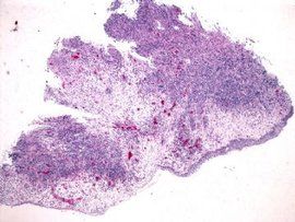 嗜酸性細胞增多症 嗜酸性細胞增多症
