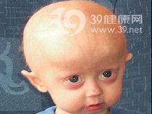 小兒早老症 小兒早老症