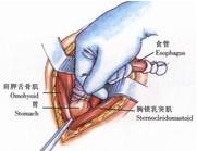 示意圖7:使胃底上達頸部切口