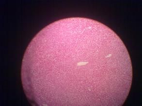 脂肪變性 脂肪變性