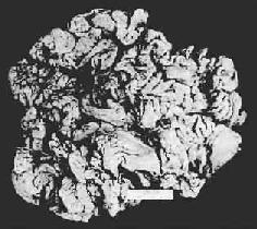 （圖）巨大肥厚性胃炎