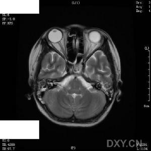小兒病毒性腦炎