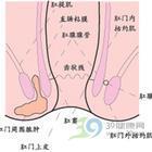 肛門瘺管 肛門瘺管