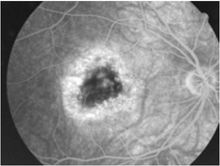 黃斑病變的診斷