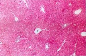 肝小靜脈閉塞症