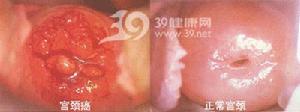 （圖）宮頸癌
