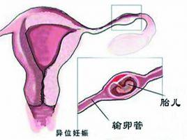 卵巢宮外孕