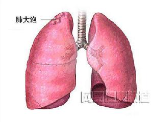農民肺