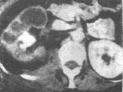 膀胱與尿道結石