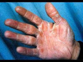 角化型手足癬 角化型手足癬