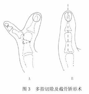 多指畸形