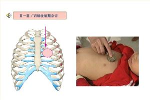 小兒先天性心臟病