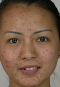 面部雀斑 面部雀斑
